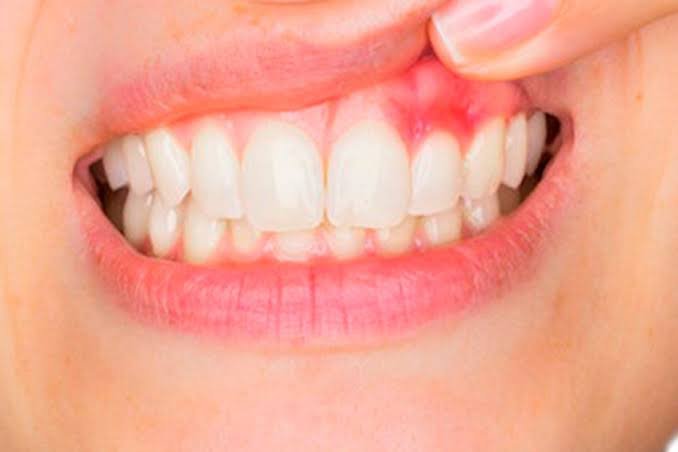 gum disease symptoms