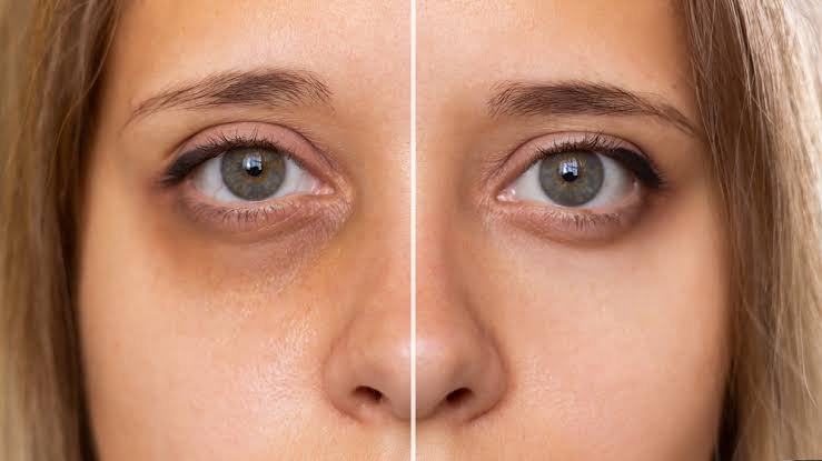 how to get rid of dark circles