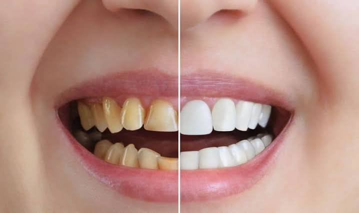 whiten teeth naturally at home